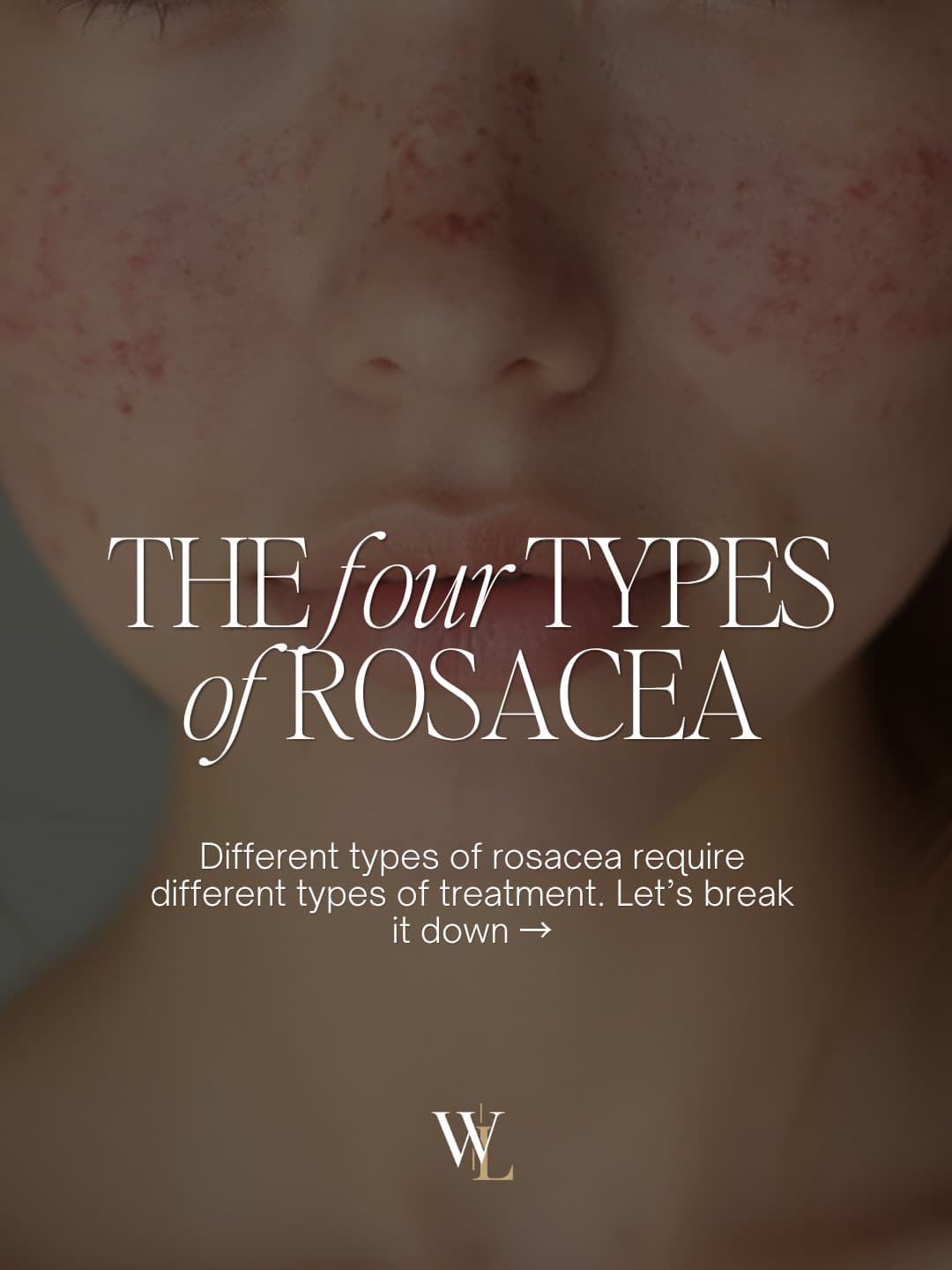 Did you know there are 4 different types of Rosacea?👇🏻
Whether you’re dealing